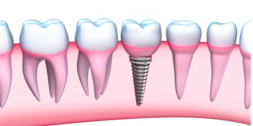 Dental Implant Dentistry Human Tooth Dentures, PNG, 1369x686px, Watercolor, Cartoon, Flower, Frame, Heart Download Free