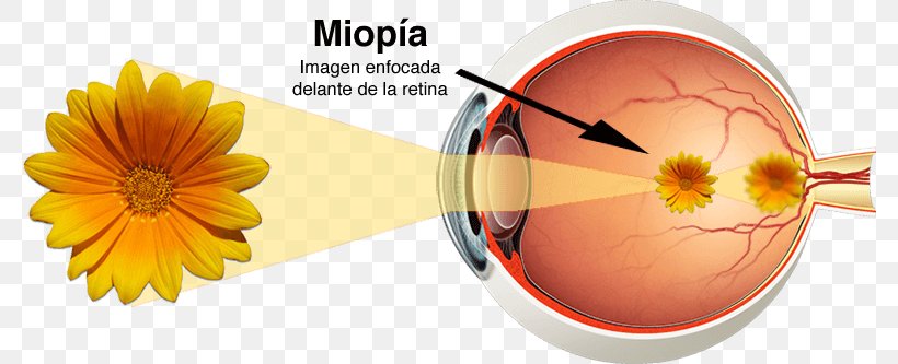 miopia retina