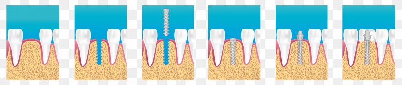Dental Implant Dentistry Surgery Bridge, PNG, 4806x1021px, Dental Implant, Blue, Bridge, Crown, Dental Restoration Download Free
