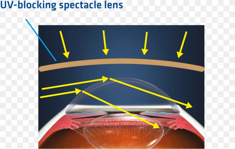 Contact Lenses Light UV-B Lamps Glasses, PNG, 886x565px, Lens, Brand, Contact Lenses, Exposure, Eye Download Free