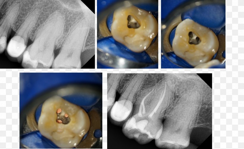 Endodontic Therapy Microscope Neurosurgery Ophthalmology Jaw, PNG, 1200x735px, Endodontic Therapy, Bone Fracture, Clinic, Falles, Finger Download Free