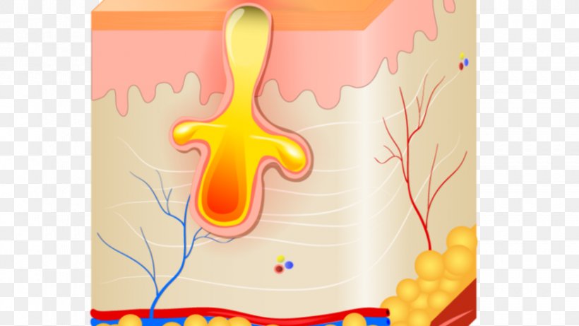 Sebaceous Gland Poil Inflammation Acne Comedo, PNG, 880x495px, Sebaceous Gland, Acne, Beard, Bouton, Comedo Download Free