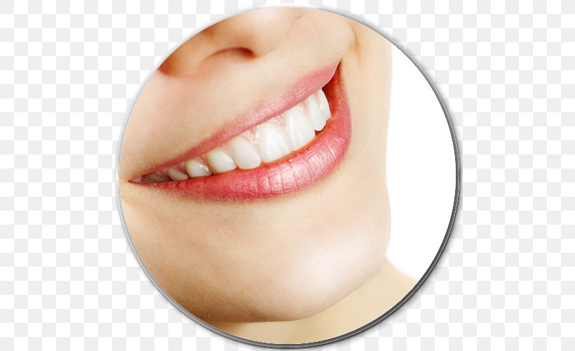 Bleach Tooth Whitening Dentistry, PNG, 500x500px, Bleach, Bridge, Cheek, Chin, Close Up Download Free