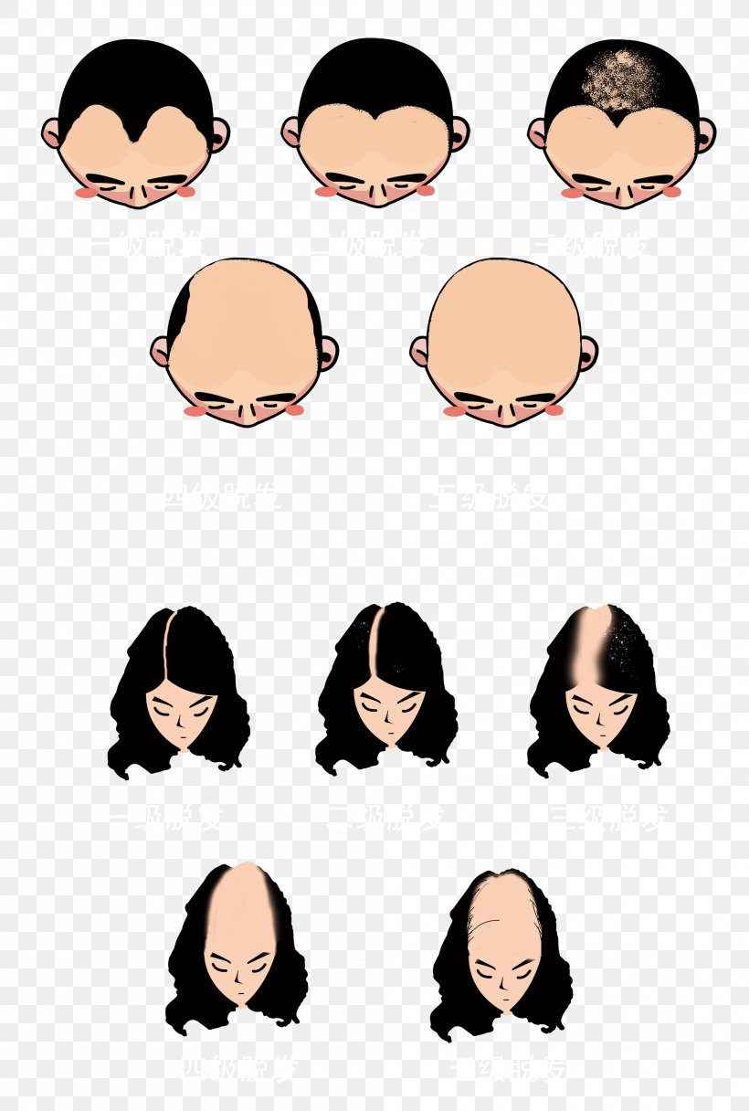 Pattern Hair Loss Head Hair Scalp, PNG, 2000x2966px, Pattern Hair Loss, Androgen, Art, Black Hair, Body Download Free