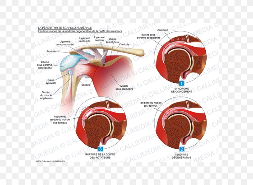 Rotator Cuff Tear Tendinitis Tendinopathy Tendon, PNG, 600x600px, Watercolor, Cartoon, Flower, Frame, Heart Download Free