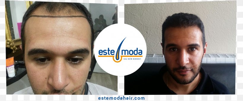 Este Moda Hair Saç Ekim Merkezi Hair Transplantation Eyebrow Capelli, PNG, 1920x800px, Hair Transplantation, Adana, Capelli, Chin, Eyebrow Download Free