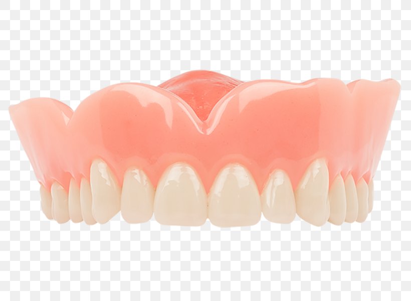 Tooth Dentures Dentistry Aspen Dental, PNG, 800x600px, Tooth, Aspen Dental, Crown, Dental Extraction, Dental Restoration Download Free