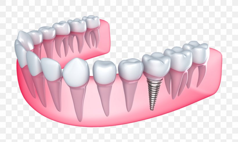 Dental Implant Dentistry Tooth Loss, PNG, 1150x686px, Dental Implant, Abutment, Bridge, Cosmetic Dentistry, Crown Download Free
