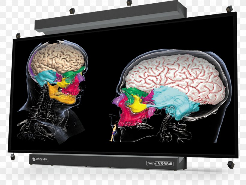 Display Device Brain, PNG, 1185x893px, Display Device, Brain, Computer Monitors, Medical Download Free