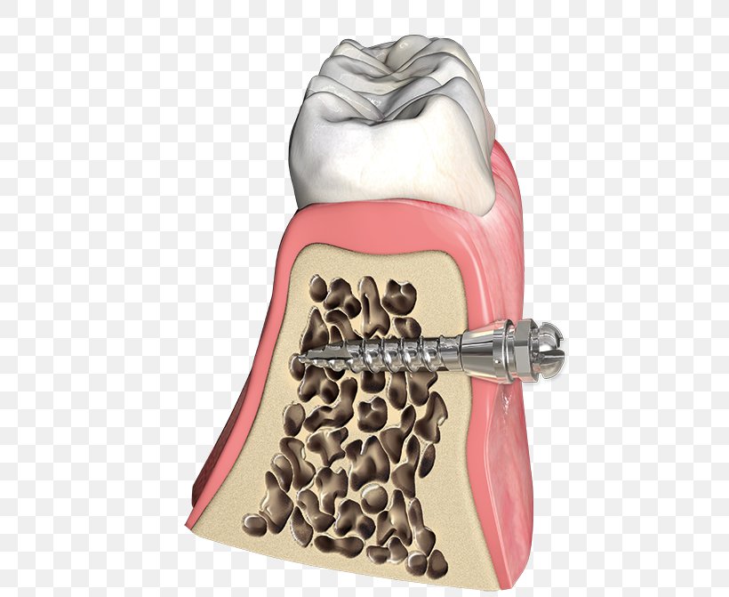 Orthodontics Jaw Dental Braces Tooth Dental Implant, PNG, 500x671px, Orthodontics, Child, Deciduous Teeth, Dental Braces, Dental Implant Download Free