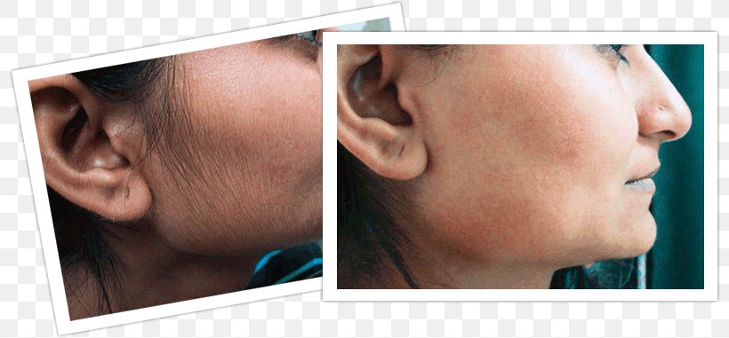 Hair Removal Facial Hair Woman, PNG, 800x381px, Hair Removal, Body Hair, Cheek, Chin, Ear Download Free