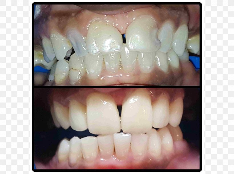Tooth Veneer Dental Implant Dentist Crown, PNG, 1024x764px, Tooth, Bone Grafting, Cosmetic Dentistry, Crown, Dental Implant Download Free