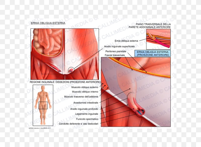 Inguinal Hernia Abdominal External Oblique Muscle Abdominal Internal Oblique Muscle Groin, PNG, 600x600px, Watercolor, Cartoon, Flower, Frame, Heart Download Free