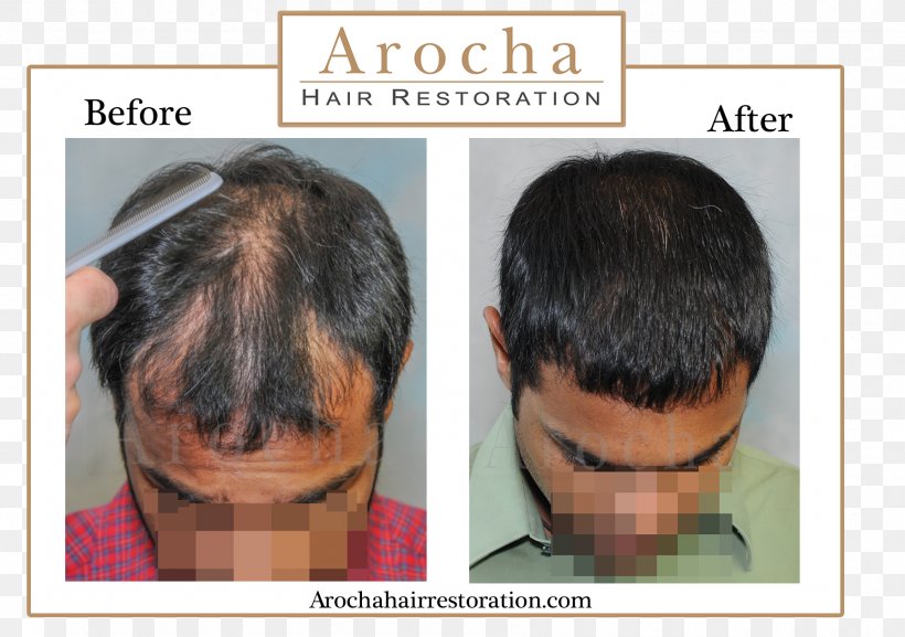 Forehead Hair Transplantation Graft Hair Loss Follicular Unit Extraction, PNG, 1790x1260px, Forehead, Cheek, Chin, Ear, Eyebrow Download Free