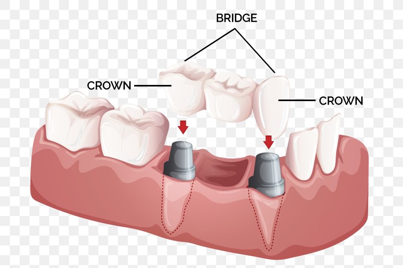 Bridge Crown Dentistry Dental Implant, PNG, 727x546px, Bridge, Cadcam Dentistry, Cosmetic Dentistry, Crown, Dental Implant Download Free