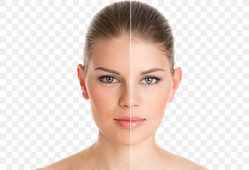 chemical peel and laser hair removal