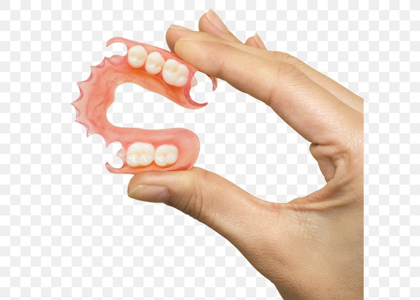 Removable Partial Denture Dentures Dentistry Prosthodontics, PNG, 600x585px, Removable Partial Denture, Bridge, Crown, Dental Hygienist, Dental Implant Download Free
