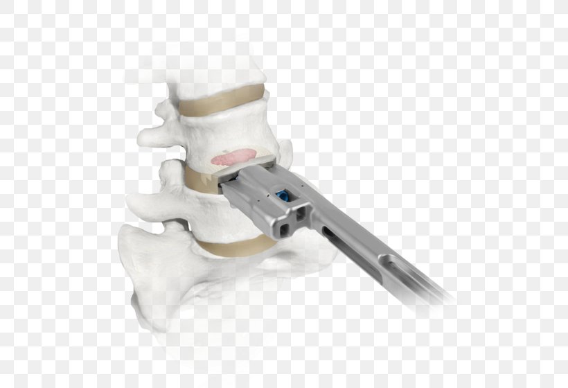Corpectomy Vertebral Column Joint Intervertebral Disc Spinal Cord, PNG, 600x560px, Corpectomy, Generation, Implant, Intelligence Quotient, Intercontinental Download Free
