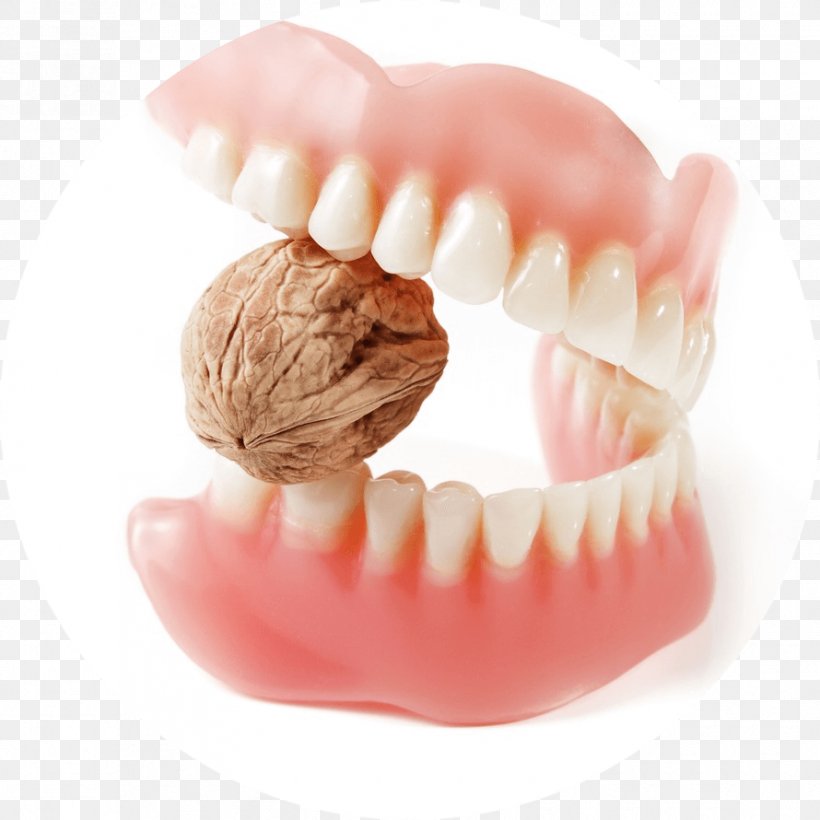 Prosthesis Tooth Bridge Royalty-free Dentures, PNG, 890x890px, Prosthesis, Bridge, Bruxism, Chin, Cracked Tooth Syndrome Download Free
