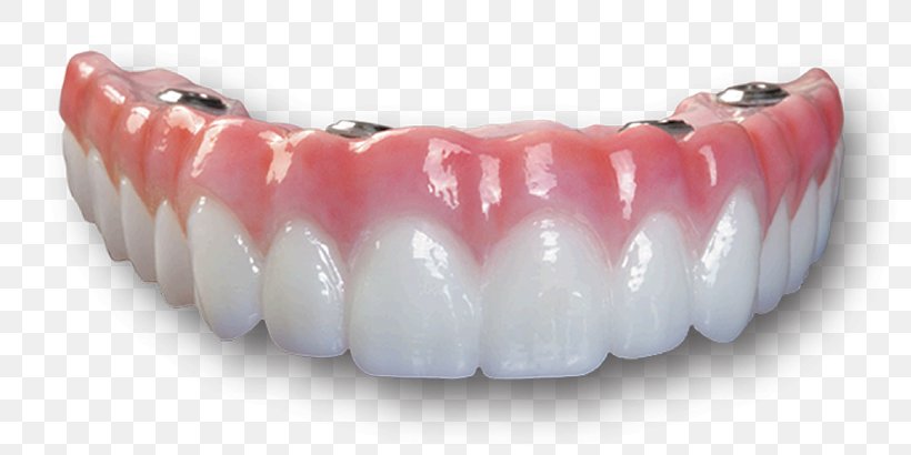 Dental Implant Bridge Dentures Dentistry All-on-4, PNG, 795x410px, Dental Implant, Abutment, Arch, Bridge, Cadcam Dentistry Download Free