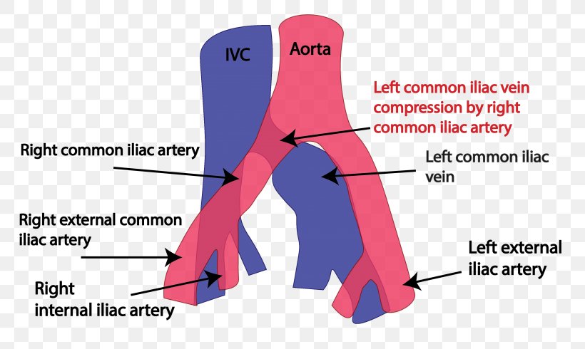 Common Iliac Vein May–Thurner Syndrome Common Iliac Artery Iliofemoral Ligament, PNG, 768x490px, Watercolor, Cartoon, Flower, Frame, Heart Download Free