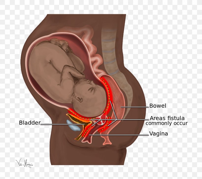 Obstetric Fistula Obstetrics Rectovaginal Fistula Childbirth, PNG, 1153x1024px, Watercolor, Cartoon, Flower, Frame, Heart Download Free