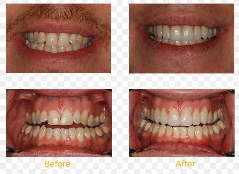 Tooth Whitening Cosmetic Dentistry Veneer, PNG, 1400x1021px, Tooth, Bridge, Clear Aligners, Cosmetic Dentistry, Dental Braces Download Free