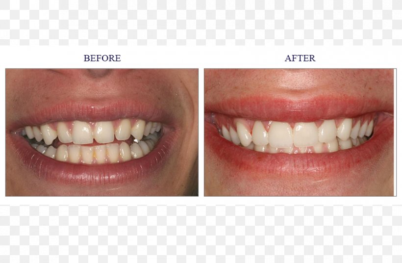 Tooth Veneer Cosmetic Dentistry Crown, PNG, 840x550px, Tooth, Chin, Close Up, Cosmetic Dentistry, Crown Download Free
