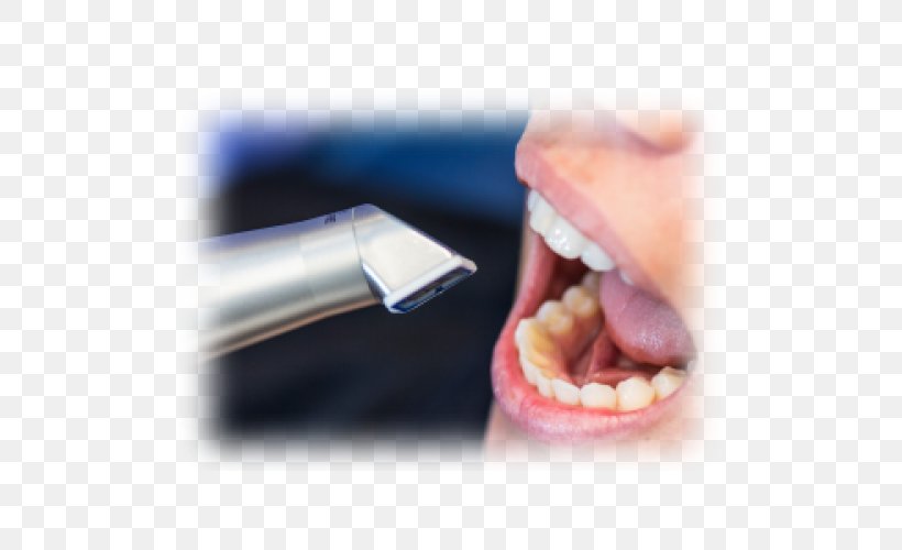 Tooth Image Scanner CAD/CAM Dentistry Escáner, PNG, 500x500px, Tooth, Cadcam Dentistry, Close Up, Crown, Dentist Download Free