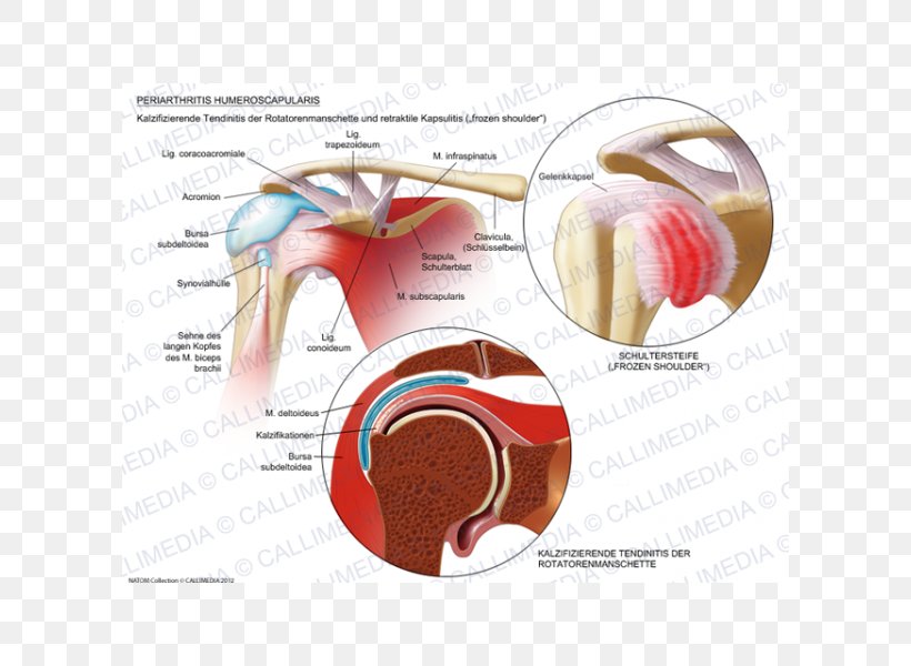 Adhesive Capsulitis Of Shoulder Periartrite Scapolo-omerale Rheumatology Shoulder Joint, PNG, 600x600px, Watercolor, Cartoon, Flower, Frame, Heart Download Free