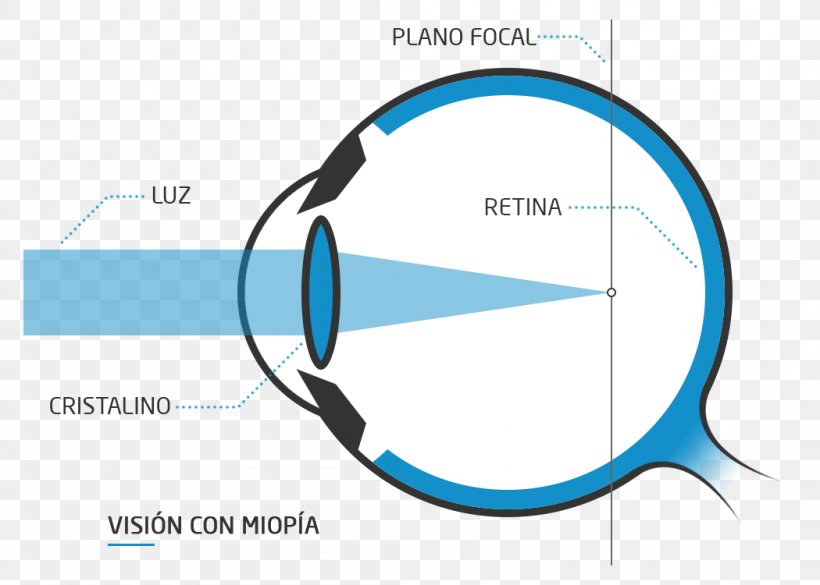 Presbyopia Floater Eye Far-sightedness Near-sightedness, PNG, 1050x750px, Presbyopia, Astigmatism, Blue, Blurred Vision, Brand Download Free