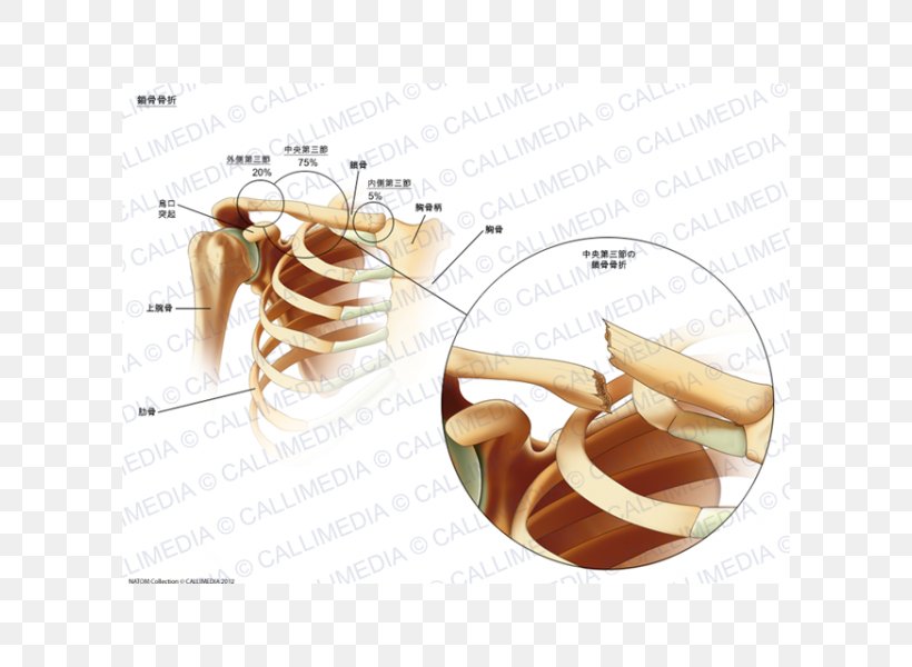 Clavicle Fracture Bone Fracture Sternum, PNG, 600x600px, Watercolor, Cartoon, Flower, Frame, Heart Download Free
