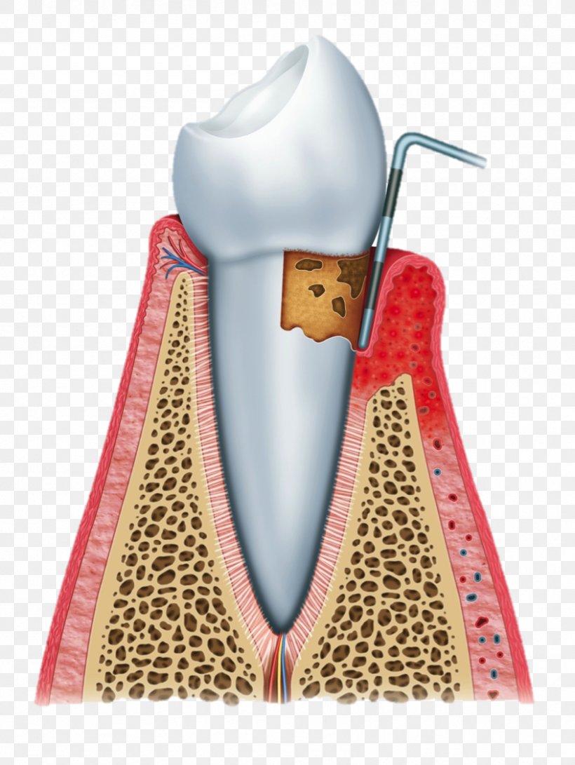 Periodontal Disease Gums Laser-assisted New Attachment Procedure Periodontology Gingivitis, PNG, 845x1125px, Periodontal Disease, Bleeding On Probing, Dental Laser, Dental Plaque, Dentist Download Free