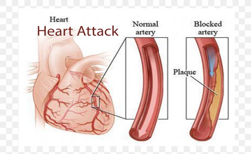 Coronary Artery Disease Coronary Arteries Cardiovascular Disease Heart, PNG, 825x510px, Watercolor, Cartoon, Flower, Frame, Heart Download Free
