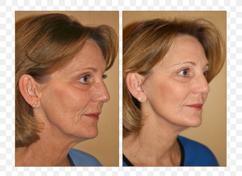Cheek Rhytidectomy Lifestyle Lift Surgery Face, PNG, 770x596px, Cheek, Chin, Clermont, Ear, Eyebrow Download Free
