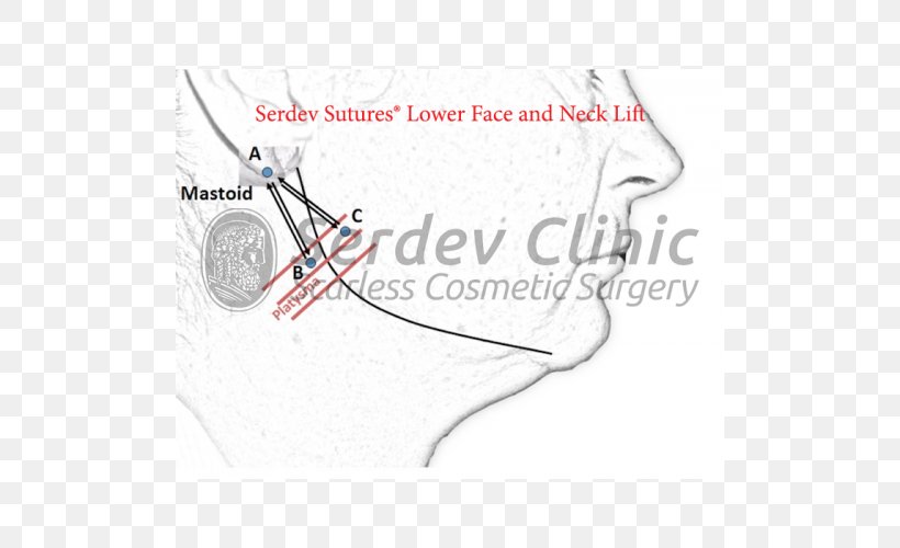 Serdev Suture Surgical Suture Surgery Rhytidectomy Superficial Muscular Aponeurotic System, PNG, 500x500px, Watercolor, Cartoon, Flower, Frame, Heart Download Free