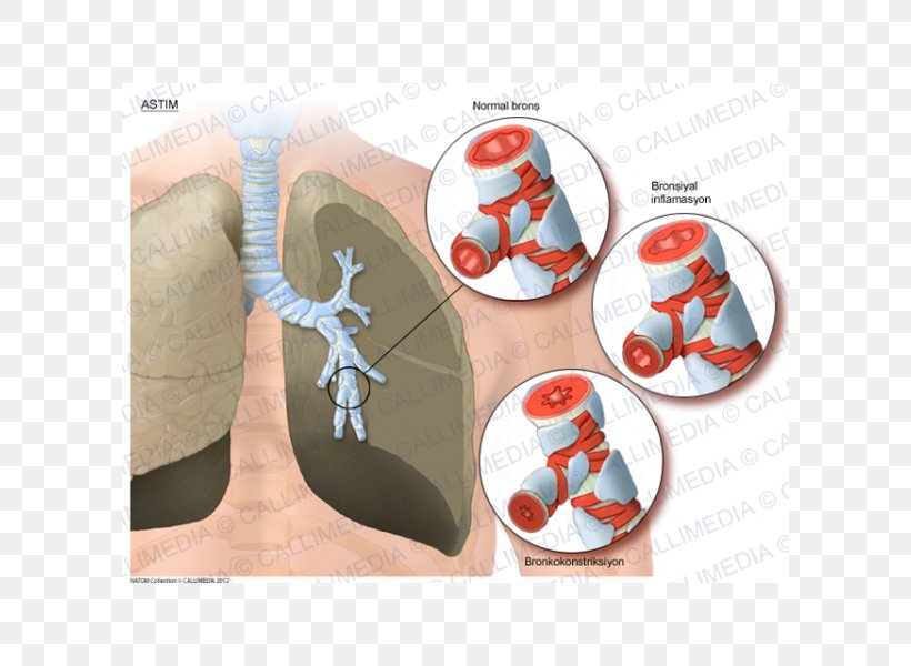 Asthma Lung Bronchus Respiratory Tract, PNG, 600x600px, Watercolor, Cartoon, Flower, Frame, Heart Download Free