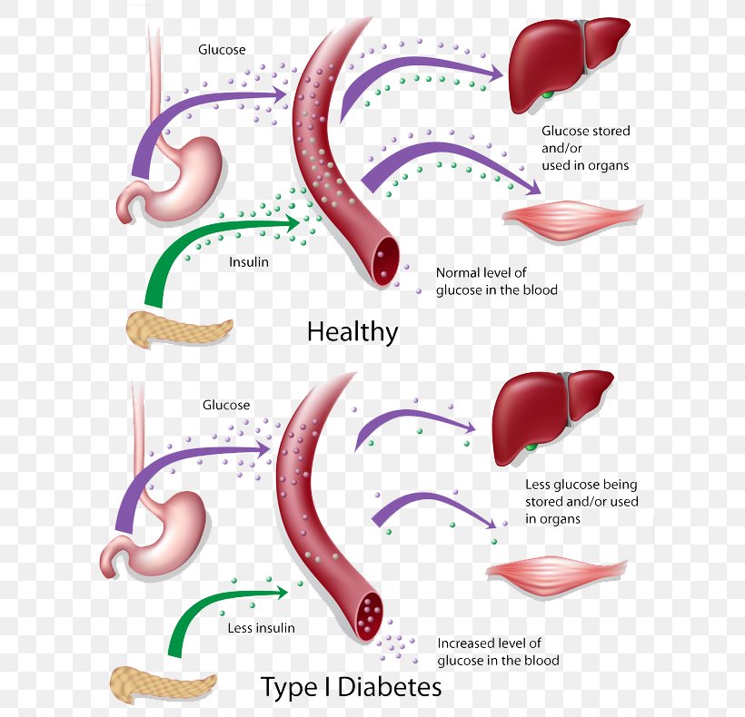 Diabetes Mellitus Type 2 Type 1 Diabetes Insulin Resistance, PNG, 632x790px, Watercolor, Cartoon, Flower, Frame, Heart Download Free
