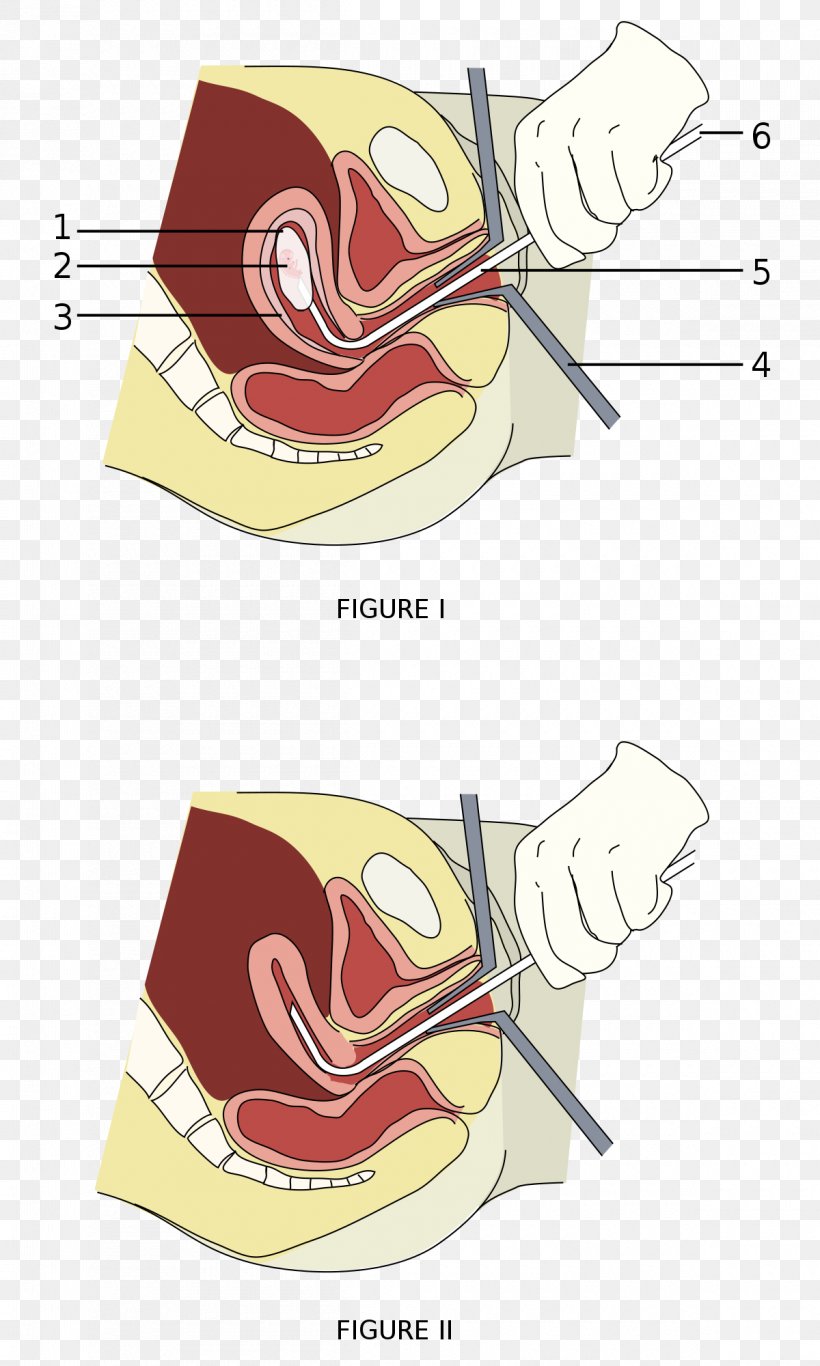 Vacuum Aspiration Surgery Abortion Miscarriage Therapy, PNG, 1200x2000px, Watercolor, Cartoon, Flower, Frame, Heart Download Free