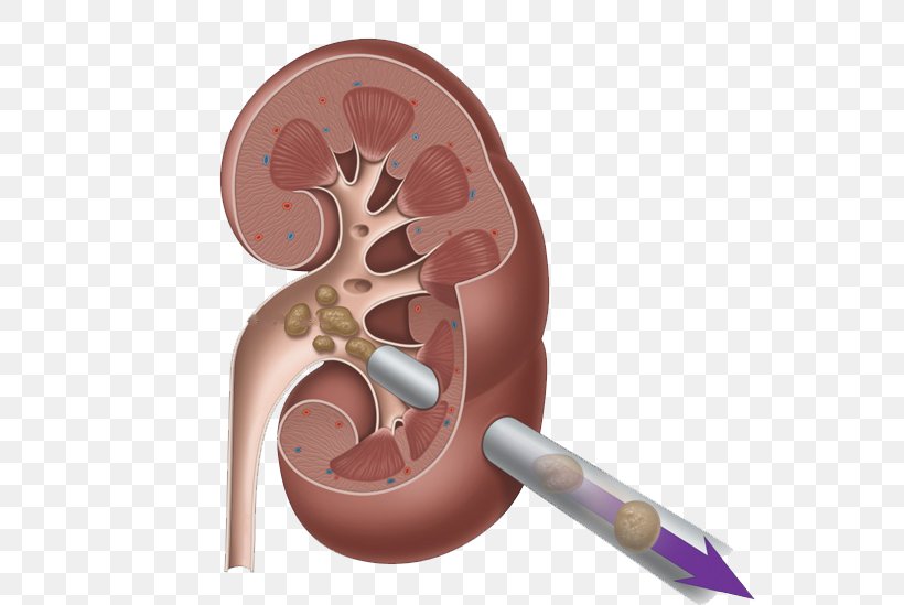 Kidney Stone Surgery Percutaneous Nephrolithotomy Ureter, PNG, 551x549px, Watercolor, Cartoon, Flower, Frame, Heart Download Free