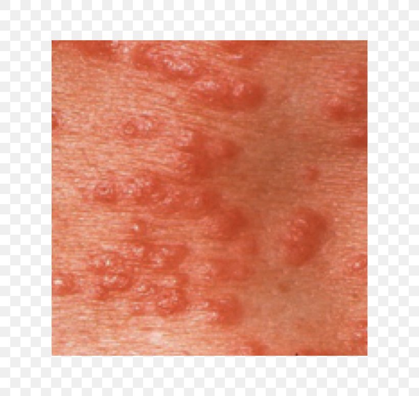 Scabies Skin Rash Close-up, PNG, 620x776px, Watercolor, Cartoon, Flower, Frame, Heart Download Free