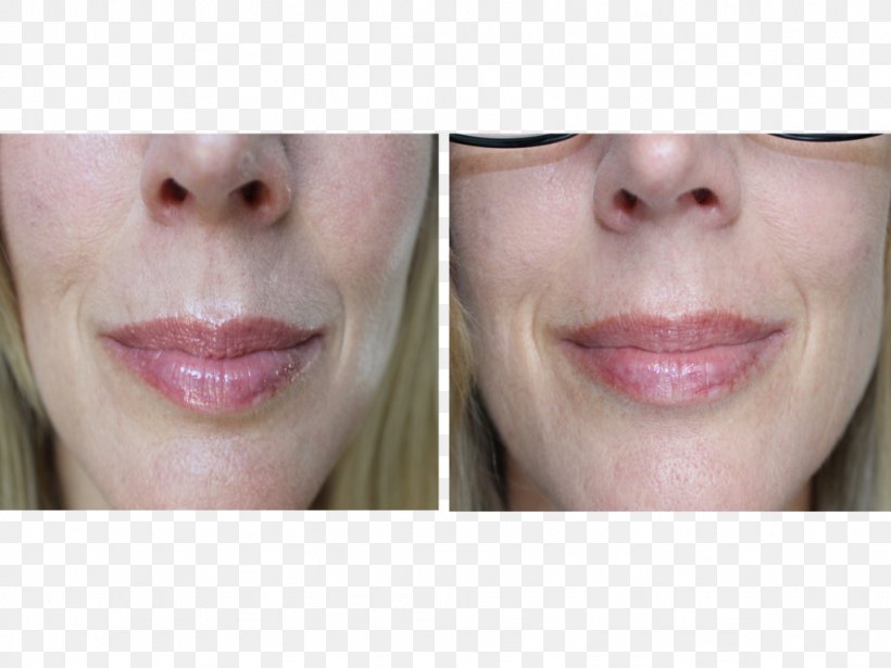 Tretinoin Lip Retinol Retinoid Wrinkle, PNG, 1024x768px, Tretinoin, Acne, Ageing, Cheek, Chin Download Free