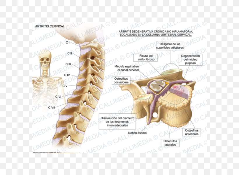Cervical Osteoarthritis Cervical Vertebrae Vertebral Column, PNG, 600x600px, Watercolor, Cartoon, Flower, Frame, Heart Download Free