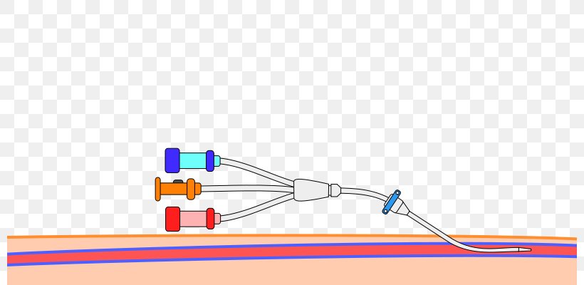 Peripheral Venous Catheter Central Venous Catheter Seldinger Technique Arterial Line, PNG, 800x400px, Catheter, Arterial Line, Artery, Blood, Blue Download Free