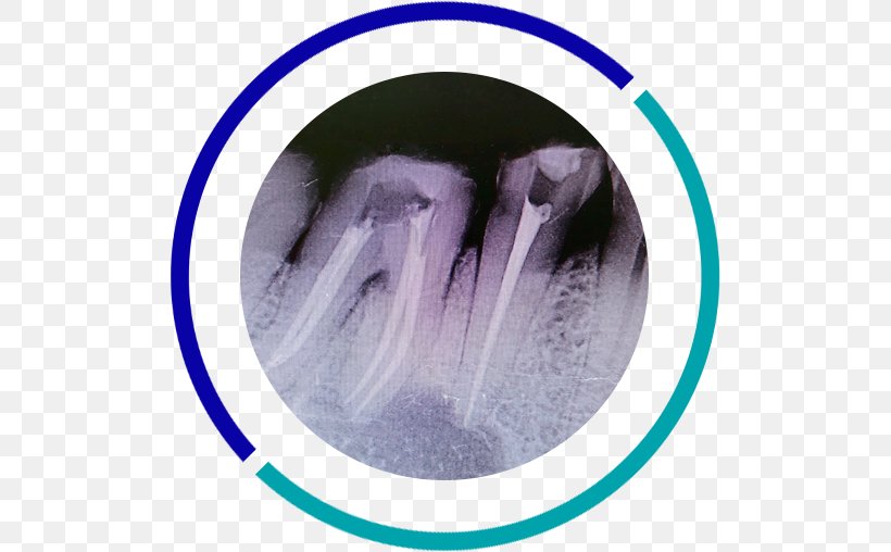 Dentistry Tooth Apicoectomy Root Canal, PNG, 507x508px, Dentistry, Apicoectomy, Dentist, Endodontic Therapy, Endodontics Download Free