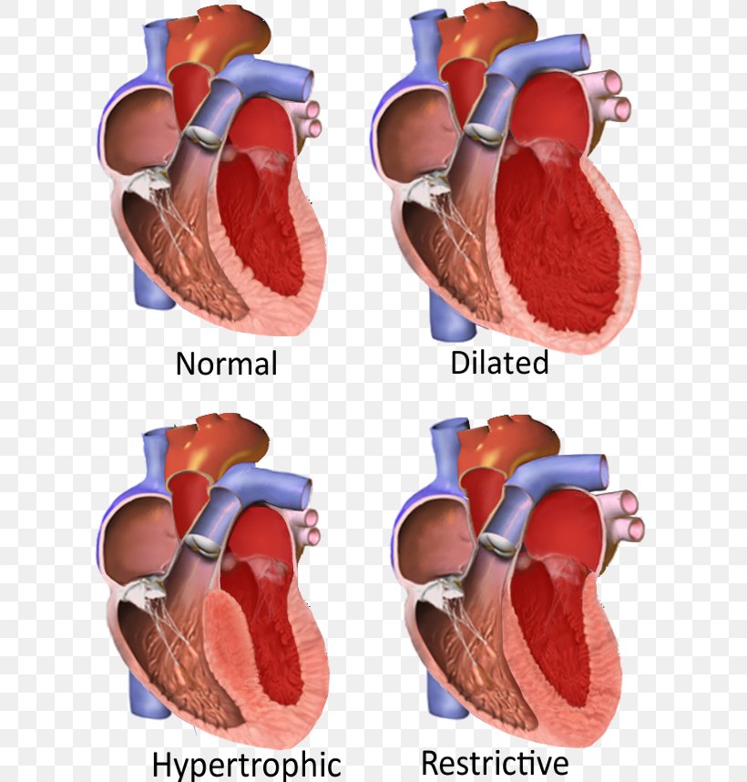 Restrictive Cardiomyopathy Dilated Cardiomyopathy Hypertrophic Cardiomyopathy Cardiac Muscle, PNG, 614x858px, Cardiomyopathy, Cardiac Muscle, Cardiomegaly, Dilated Cardiomyopathy, Disease Download Free