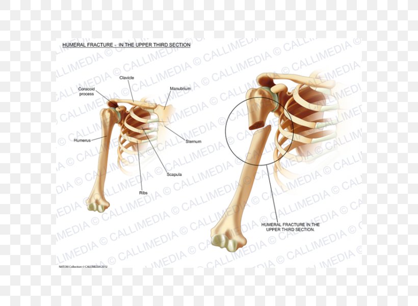 Humerus Fracture Bone Fracture Injury Sternum, PNG, 600x600px, Watercolor, Cartoon, Flower, Frame, Heart Download Free