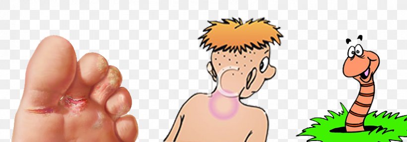 Ringworm Skin Infection Mycosis Tinea Capitis, PNG, 848x296px, Ringworm, Arm, Art, Cartoon, Cause Download Free