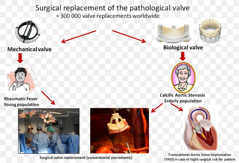 Brand Aortic Valve Valvular Aortic Stenosis, PNG, 1441x987px, Brand, Aortic Valve, Ear, Text, Valvular Aortic Stenosis Download Free