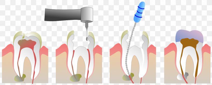 Endodontic Therapy Root Canal Dentistry Endodontics, PNG, 1250x500px, Endodontic Therapy, Ache, Brush, Crown, Cutlery Download Free